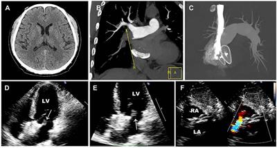 Case report: Bi-atrial thrombus after occlusion of atrial septal defect with acute cerebral infarction and pulmonary embolism